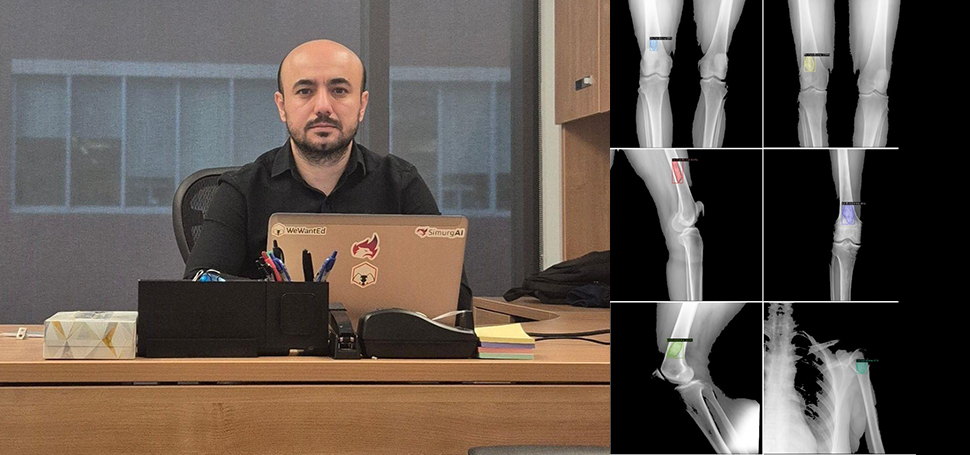 KBÜ Kemik Dokusu Üzerindeki Tümörü Yapay Zeka ile Tespit Etti
